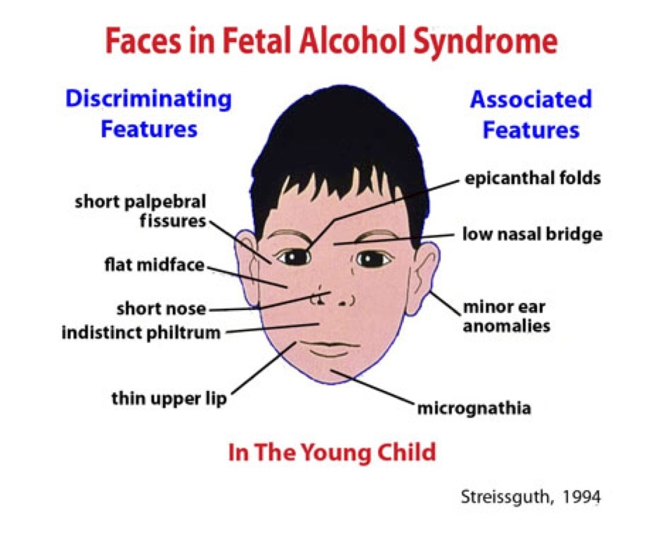 fetal alcohol syndrome eyes far apart